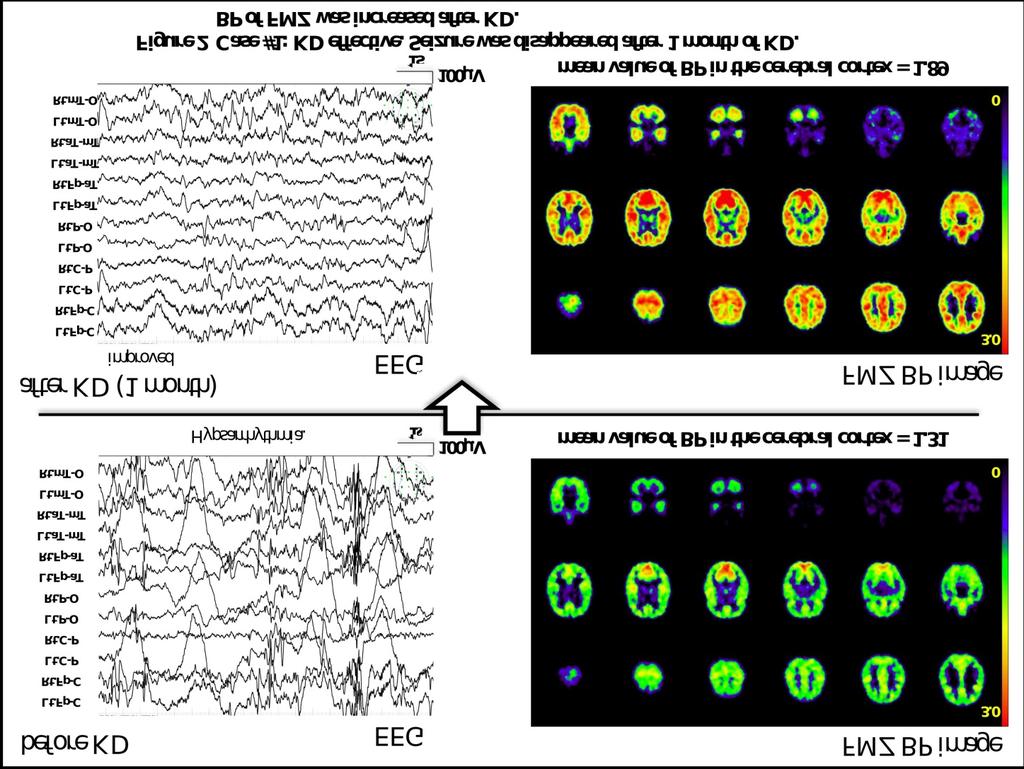 FMZ-PET to assess the efficacy and the mechanism of ketogenic diet in patients with intractable epilepsy RESEARCH PAPER Figure 2.