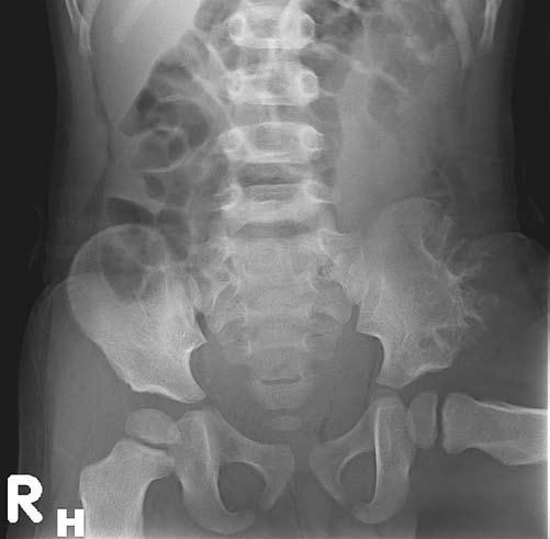 136 Low-Grade condrosarcoma in a 3-year-old boy DISCUSSION The striking feature of this case is the young age of the patient.