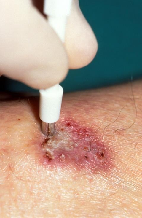 the lesion is Do not biopsy