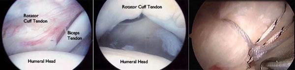(Left) An arthroscopic view of a healthy shoulder joint. (Center) In this image of a rotator cuff tear, a large gap can be seen between the edge of the rotator cuff tendon and the humeral head.