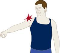 A rotator cuff injury can make it painful to lift your arm out to the side. Tears that develop slowly due to overuse also cause pain and arm weakness.
