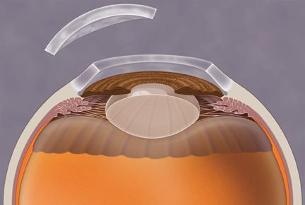 Abnormal cornea is removed Healing time after DALK is shorter than after a full cornea transplant. There is also less risk of having the new cornea rejected.