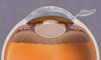 With DSAEK, only the damaged innermost layer of the cornea (called endothelium) is removed. It is called stripping because the diseased cells are stripped from the back of the cornea.