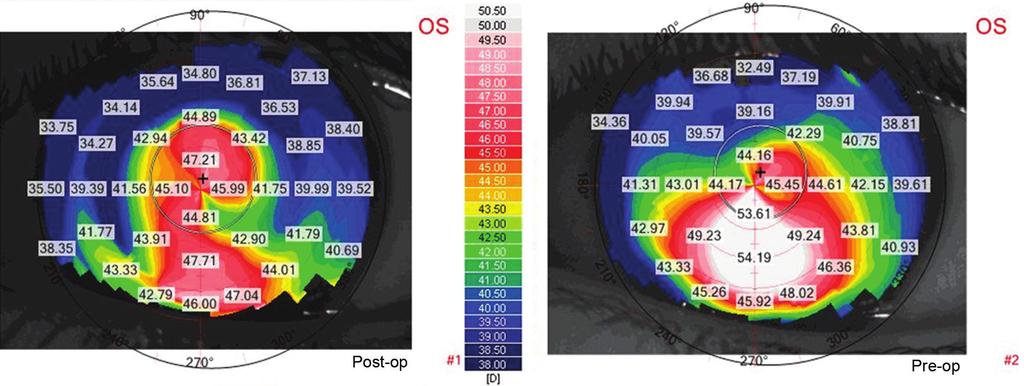 IJKECD Simultaneous Topography-guided Surface Ablation with Collagen Cross-linking for Keratoconus Fig. 1: RE Case 1 Difference Map preoperative map showing inferior steepening.