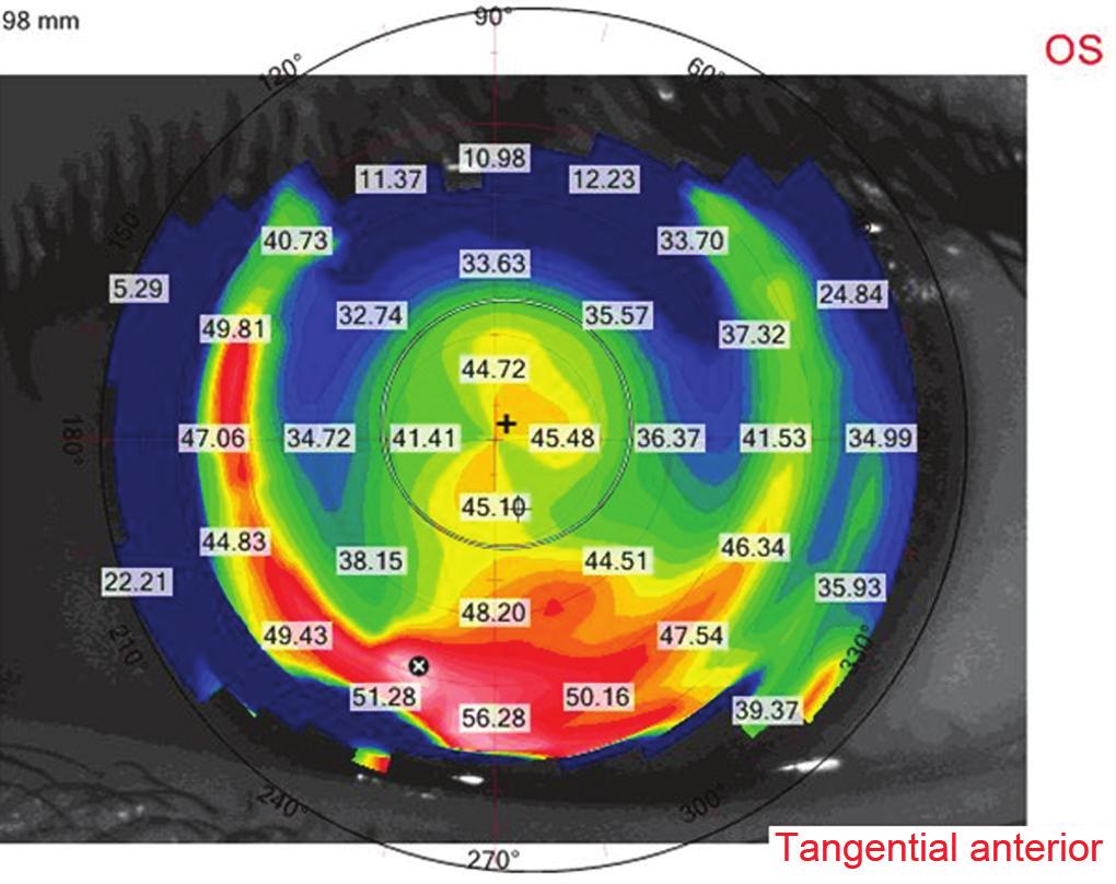 IJKECD Simultaneous Topography-guided Surface Ablation with Collagen Cross-linking for Keratoconus Fig.