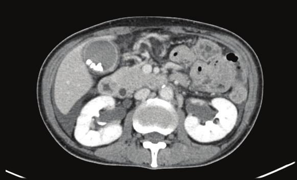 Case Reports in Medicine 3 (a) (b) (c) (d) (e) (f) (g) (h) Figure 1: Enhanced abdominal CT on admission