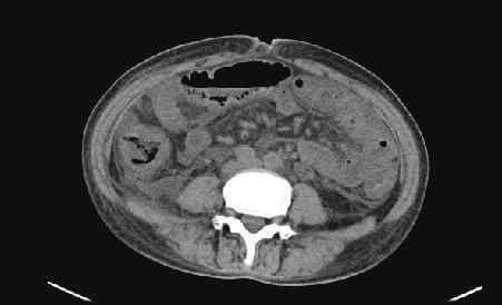 Eight days later, plain abdominal CT revealed an almost normal gall bladder wall (b, arrow), alimentary tract