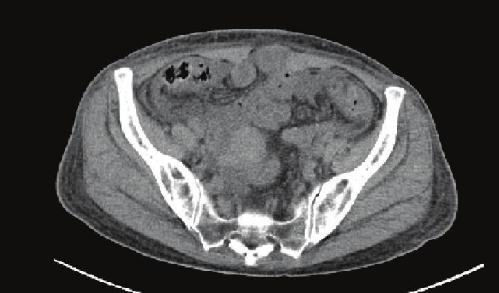 Gastrointestinal (GI) manifestations occur in approximately 25% 40% of patients with SLE [9 12].