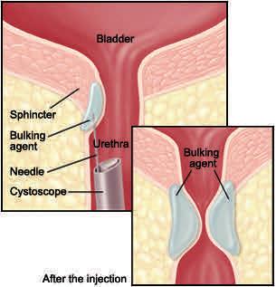 What are urethral bulking agents? Urethral bulking agents are substances that are injected to support the bladder neck.