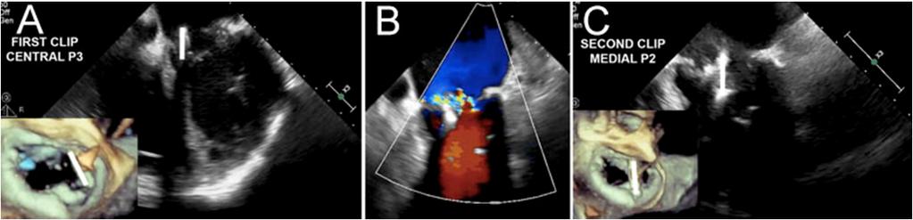 Intra-procedural trans-esophageal echocardiogram and superimposed 3-D reconstruction highlighting the location of the first clip location at