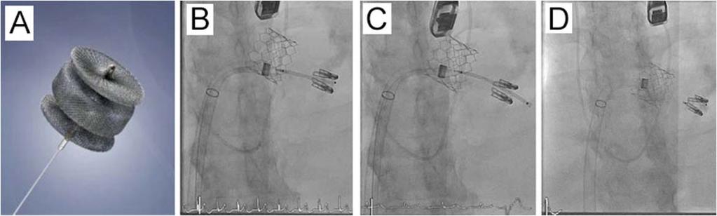 Figure 5: A. 10 mm Amplatzer Vascular Plug (AVP) II device, with two retention discs and a flexible delivery cable. B-D. Sequential intra-procedural fluoroscopy of occluder placement Figure 6: A.