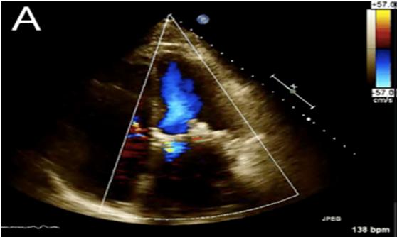 Figure 7: A. 30-day follow up trans-thoracic echocardiogram with color Doppler highlighting trace final MR s/p 10 mm AVP II, in addition to demonstrating adequate valve function 3.