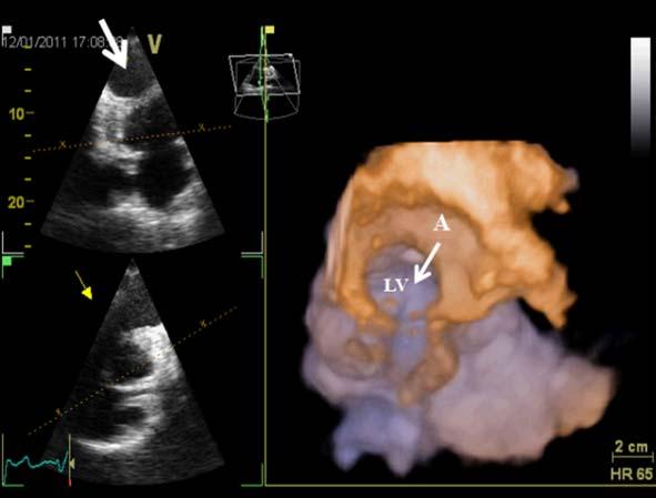 Differential diagnosis between aneurysm and pseudoaneurysm was made by three-dimensional echocardiography (see Figure 3) and contrast ventriculography (see Figure