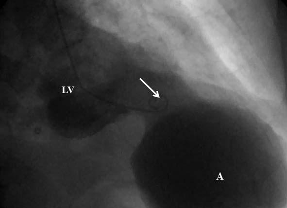 Three-dimensional transthoracic echocardiogram confirming a large communication between the left ventricle (LV) chamber and aneurysm (A). Figure 4.