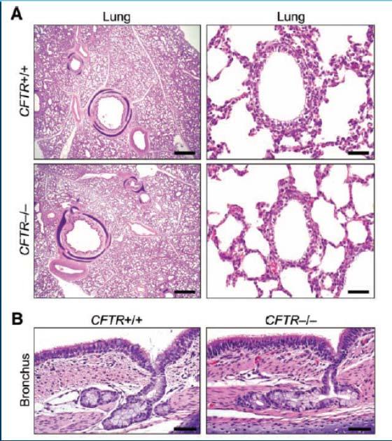The CF lung is nearly normal at birth Early pulmonary inflammation in CF 16 CF infants (mean