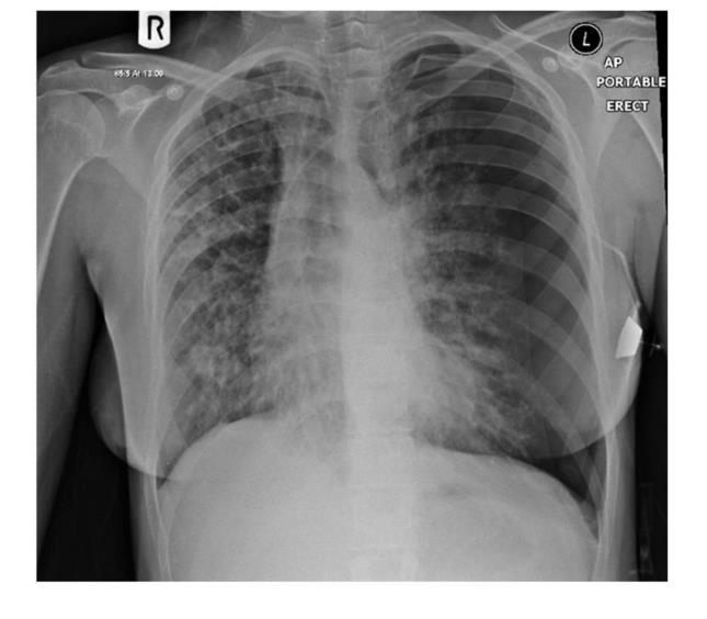 Pneumothorax in CF Lifetime incidence = 3.