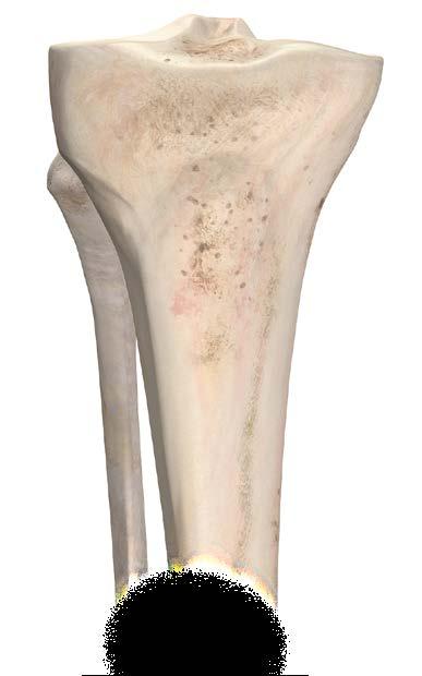 Surgical Tips and Pearls Tibial Pin Guide a. The Tibial Pin Guide s primary reference surface is the anterior/medial aspect of the tibia.