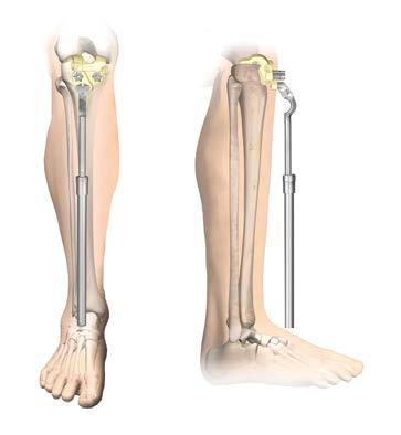 The planned Varus/Valgus (V/V) alignment can be confirmed by verifying the alignment of the rod to the patient s tibial crest and center of the ankle (Figure 5).