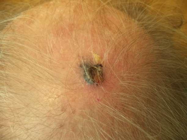 Ulcerated pigmented nodule on elderly white sun damaged skin-bad news.