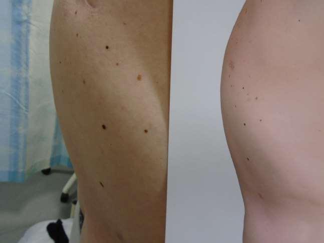 How to use mole mapping spot the difference At it s simplest, monitoring consists of comparing the patient s whole skin