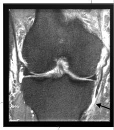 swelling CRUCIATE INJURY X-rays can show calcification in MCL chronic injury (Pelligrini-Stieda lesion) MRI key study for