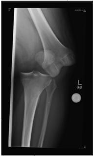 suspicion for knee dislocation Evaluation Complete neurovascular asssesment