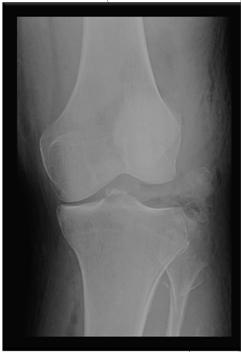 Imaging Xrays Important to identify avulsion or tibial plateau fratures Can be treated with early repair recognized early Standing hip/knee/ankle views