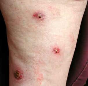 What Are Skin Lesions?