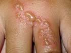 Blisters: a small bubble on the skin filled with