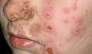 Secondary skin lesions include: Crust : a crust, or