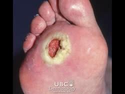 scratched and irritated skin lesion Ulcer :