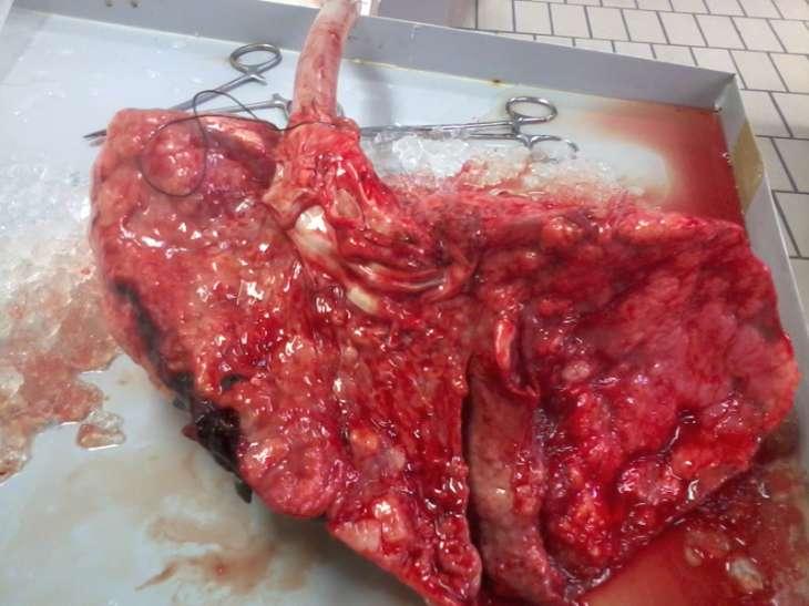 Autopsy lung Courtesy Dr Stijn