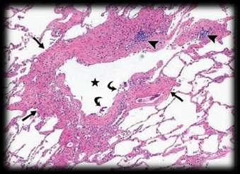 GVHD of the lungs Fibrosis RAS Restrictive Allograft Syndrome Pulmonary infiltrates Pleural