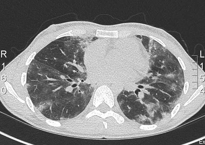 D230 High resolution CT lung