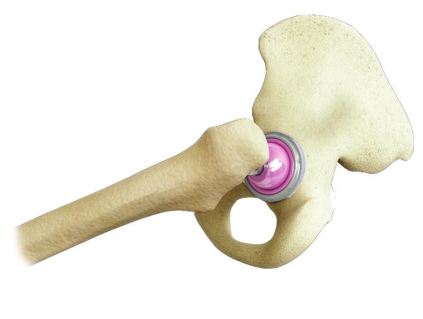 Using a firm tap, impact the definitive femoral head using the head impactor, ensuring the surface of the head is not scratched or damaged in any way.