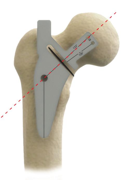 Femoral Elevation: Inferior Capsular Release Put the leg in the figure 4 position and release the pubo-femoral ligament (medial capsule) down to the lesser trochanter.