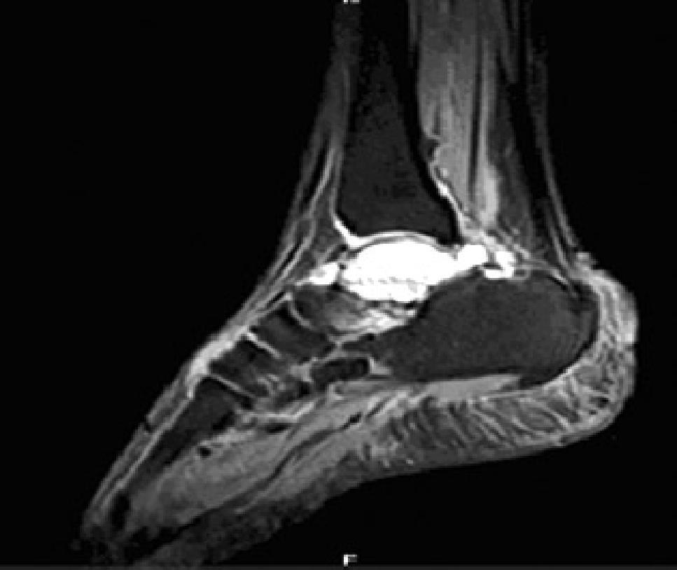 Cas e Re port 2 A 38 years old male presented with pain in the left ankle joint since 1 year. The pain aggravated with walking and movements.