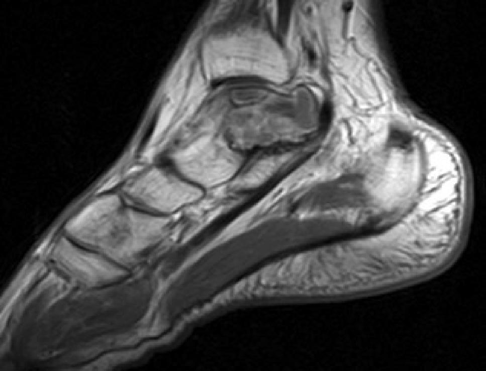 Plain radiograph of foot demonstrated a radiolucent lytic lesion involving the body, neck and tail of the talus with expansion and thinning of the cortex.