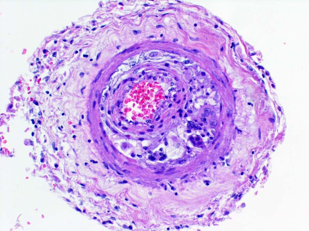 Primary CNS Vasculitis Histological