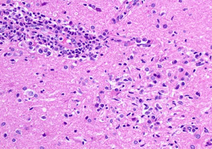 Viral encephalitis Perivascular lymphoid cuffing and microglial nodules are non-specific histological features