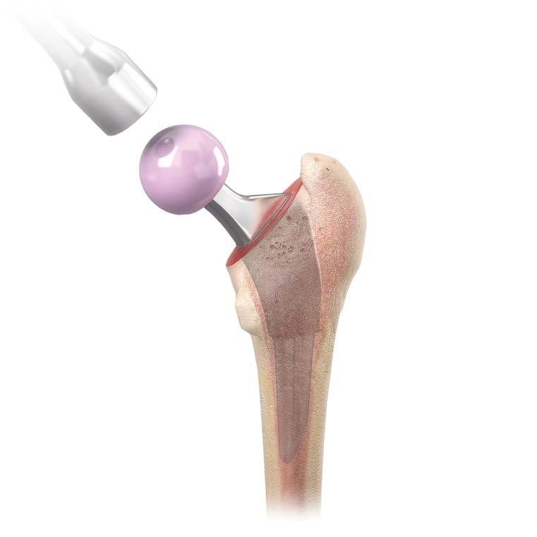 Surgical Technique 7. Femoral Head Impaction Following the final trial reduction, clean and dry the taper to ensure it is free of debris.