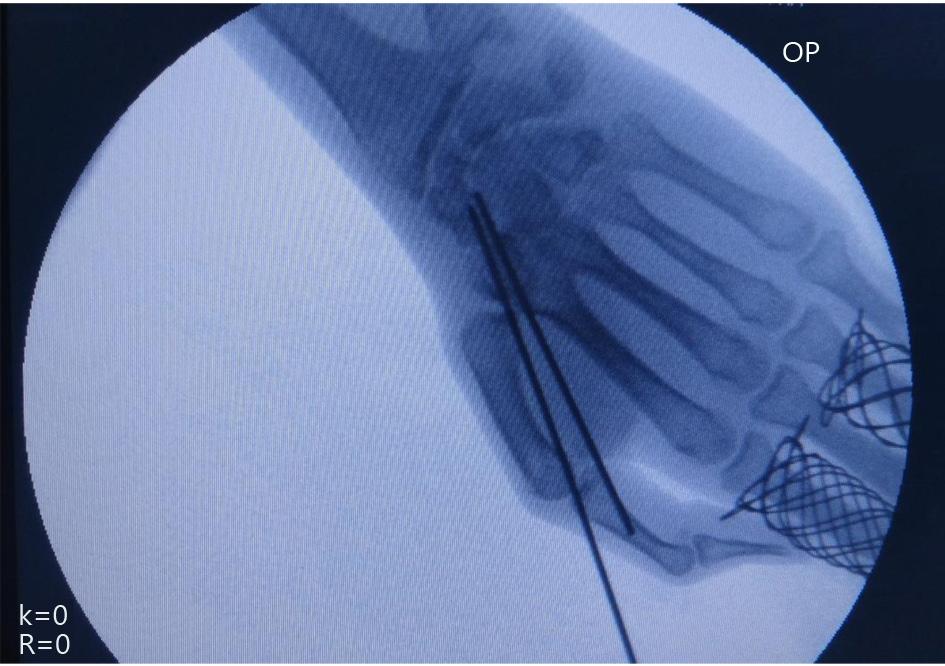 The ulnar portal was useful for removing sclerotic or devitalized tissue from nonunion site with a motorized 2 mm burr under wet arthroscopy (Figure 2).