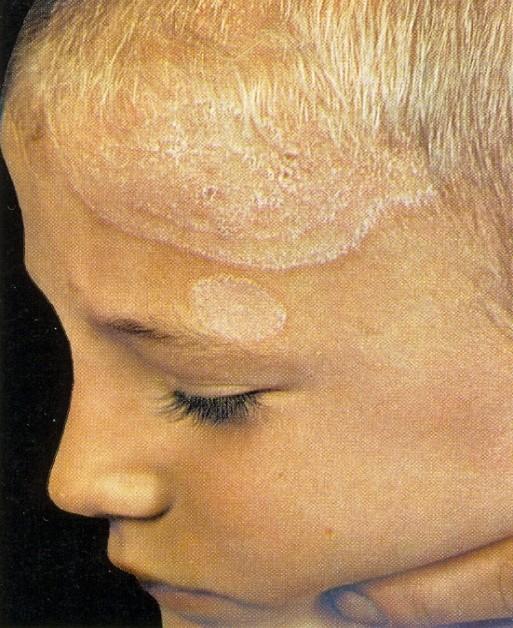 Dermatophytoses (ringworm) and superficial forms of candidosis Many