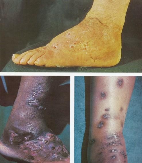 Subcutaneous mycoses Infections involving the dermis, subcutaneous tissues and bone Infections are usually acquired as a result of the traumatic implantation of organisms that grow as saprobes