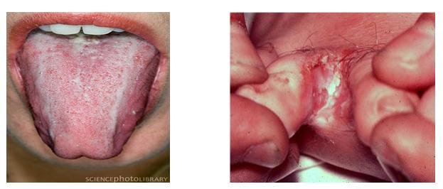 oropharyngeal candidiasis (of the oral pathway), and 10% develop esophageal candidiasis (Perkins, 2007).