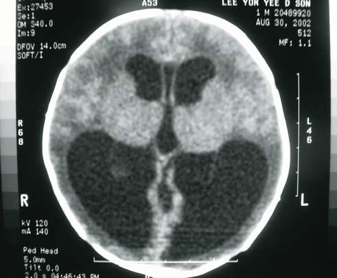 198 of the VP shunt tip on CT scan.