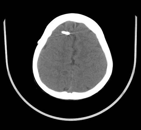 Thus, emergent VP shunt insertion was done the Figure 1. Brain CT without contrast revealed dilated bilateral lateral ventricles and third ventricle.