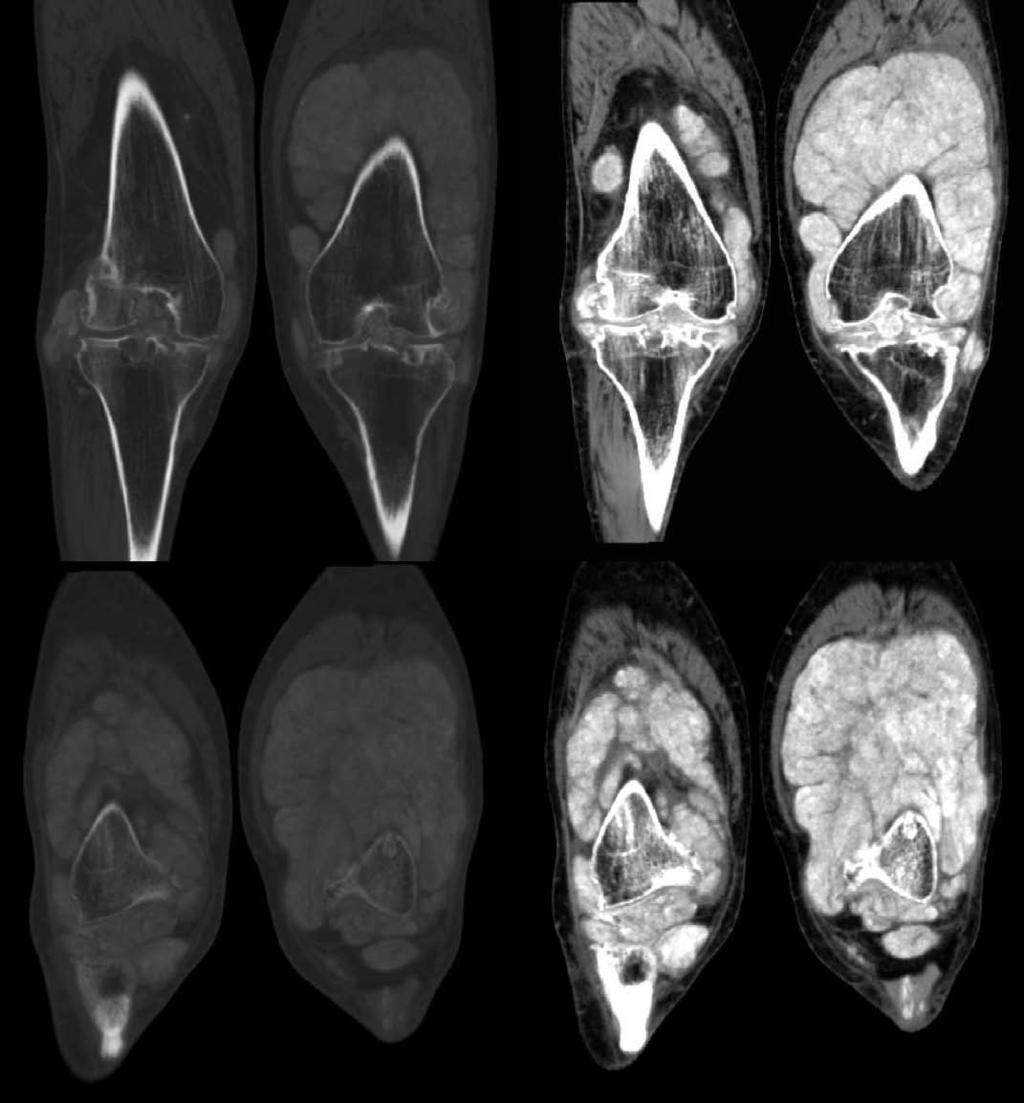 Fig. 5. Coronal non-enhanced CT images of the patient s knees show diffuse lobulated hyperdense synovial tophaceous deposits measuring 160-175 Hounsfield units.