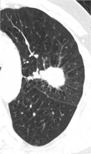 Emphysema Larger nodule size Location