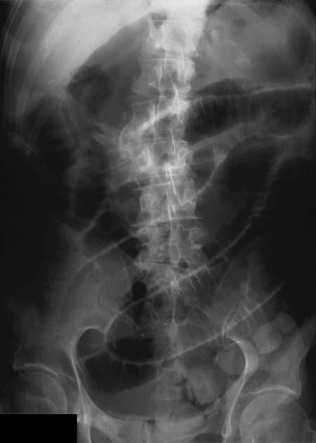 16 The upper gastrointestinal tract II From superior mesenteric artery Redder wall Jejunal branches Ileal branches Simple arcades Multiple arcades Jejunum Thicker wall (feels full) Ileum Thinner wall